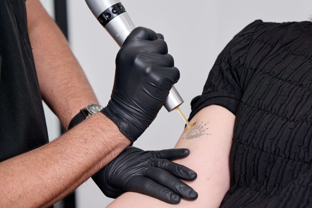 Laser Tattoo Removal in Dubai