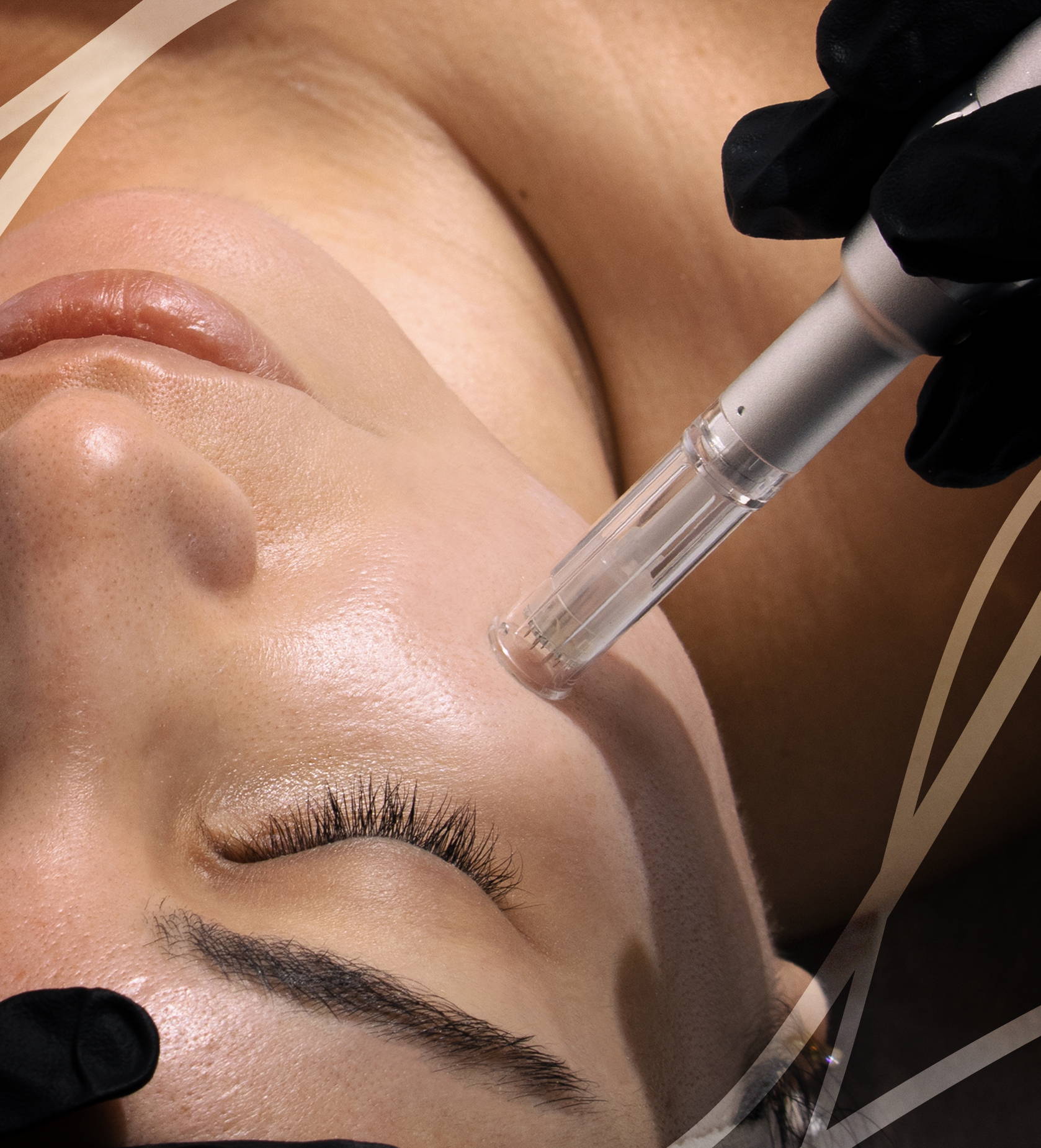 You can not stop aging, but you can decrease the signs of aging. Dynamic Clinic Dubai brings you Microneedling in Dubai with special offers. Grab it Now!