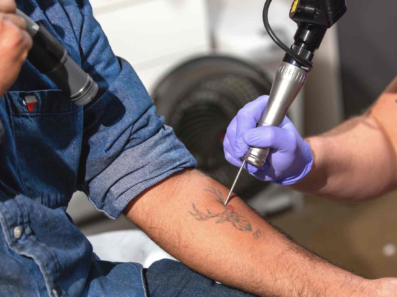 Opt for Laser Tattoo Removal in Dubai to permanently get rid of your tattoos without suffering from botched results.