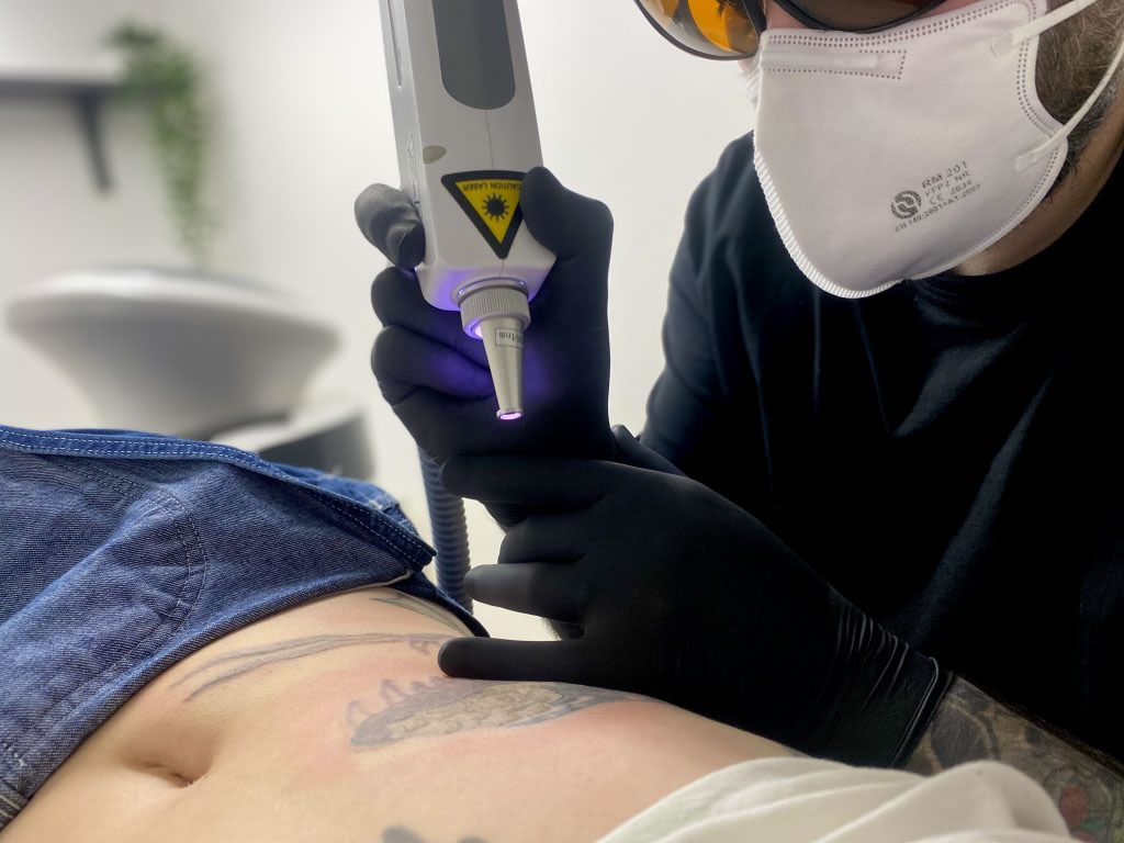 Laser Tattoo Removal in Dubai