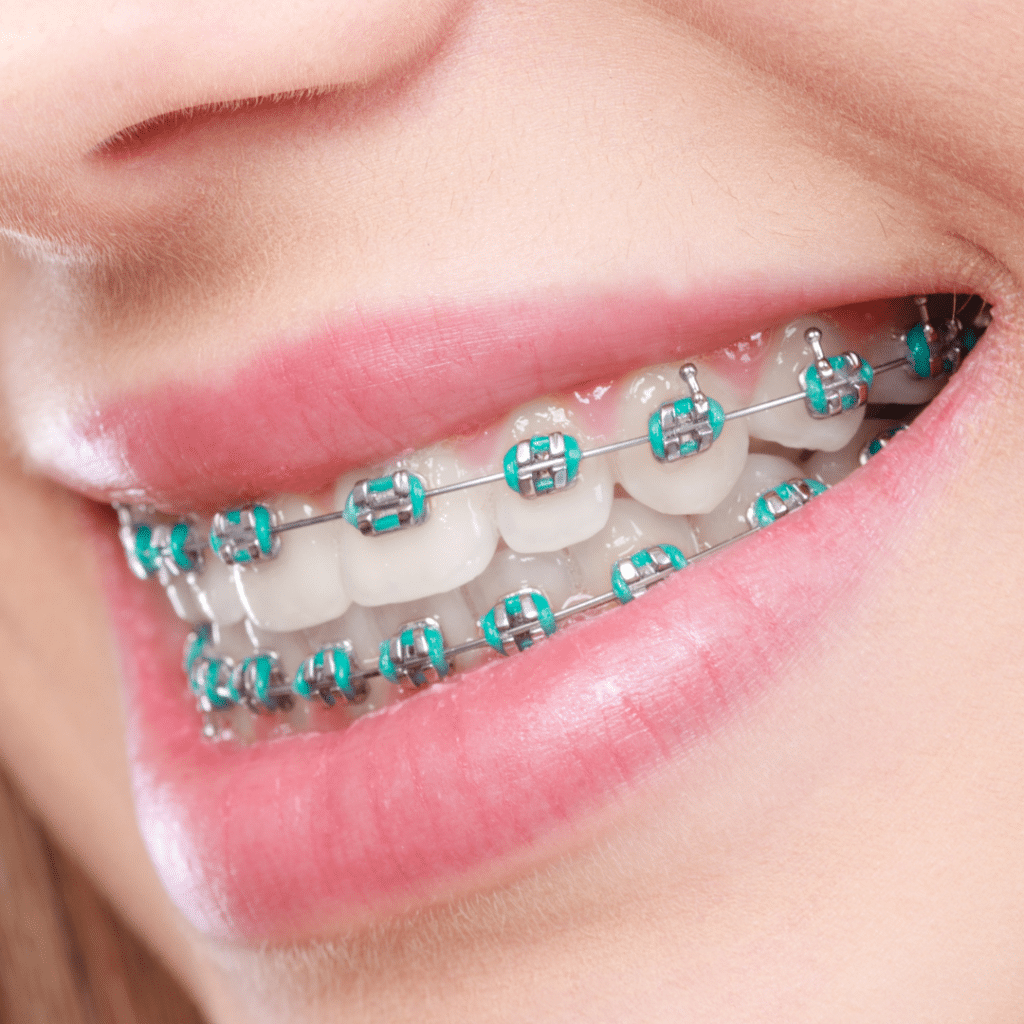 Metal Braces in Dubai