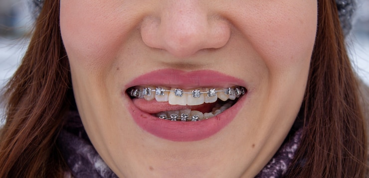 Metal Braces in Dubai