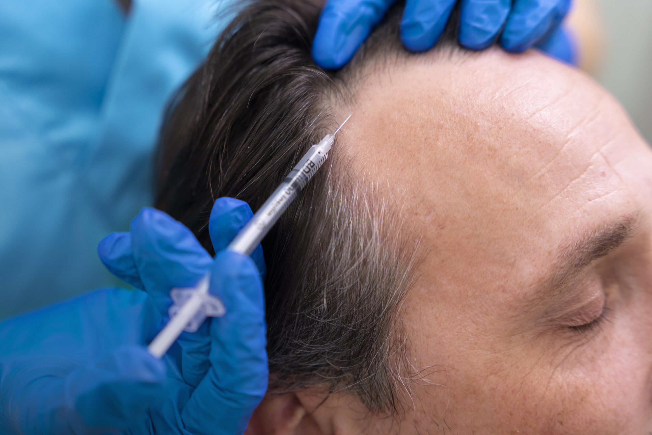 FUE Hair Transplants In Dubai