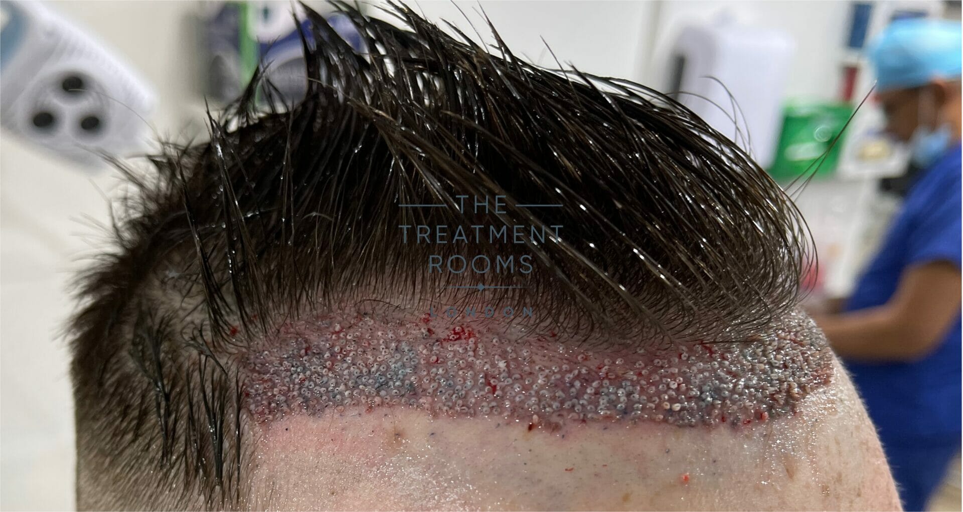 FUE Hair Transplant In Dubai