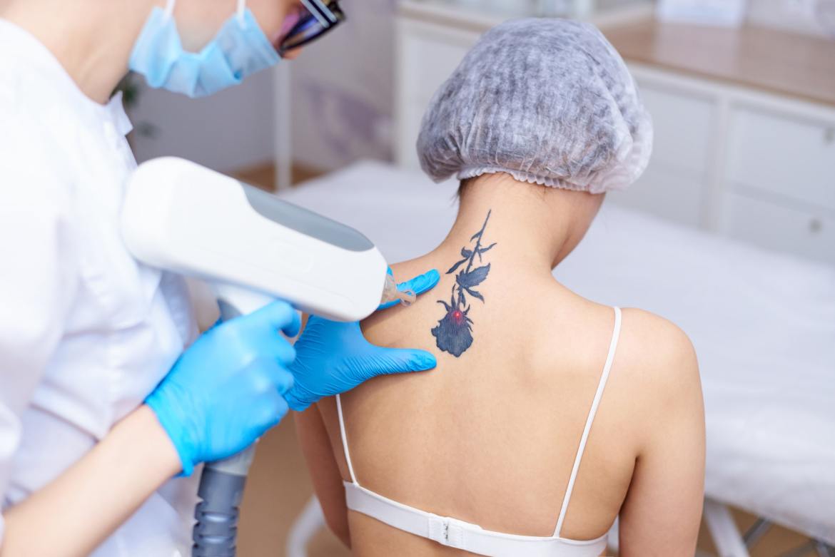 Laser Tattoo Removal in Dubai