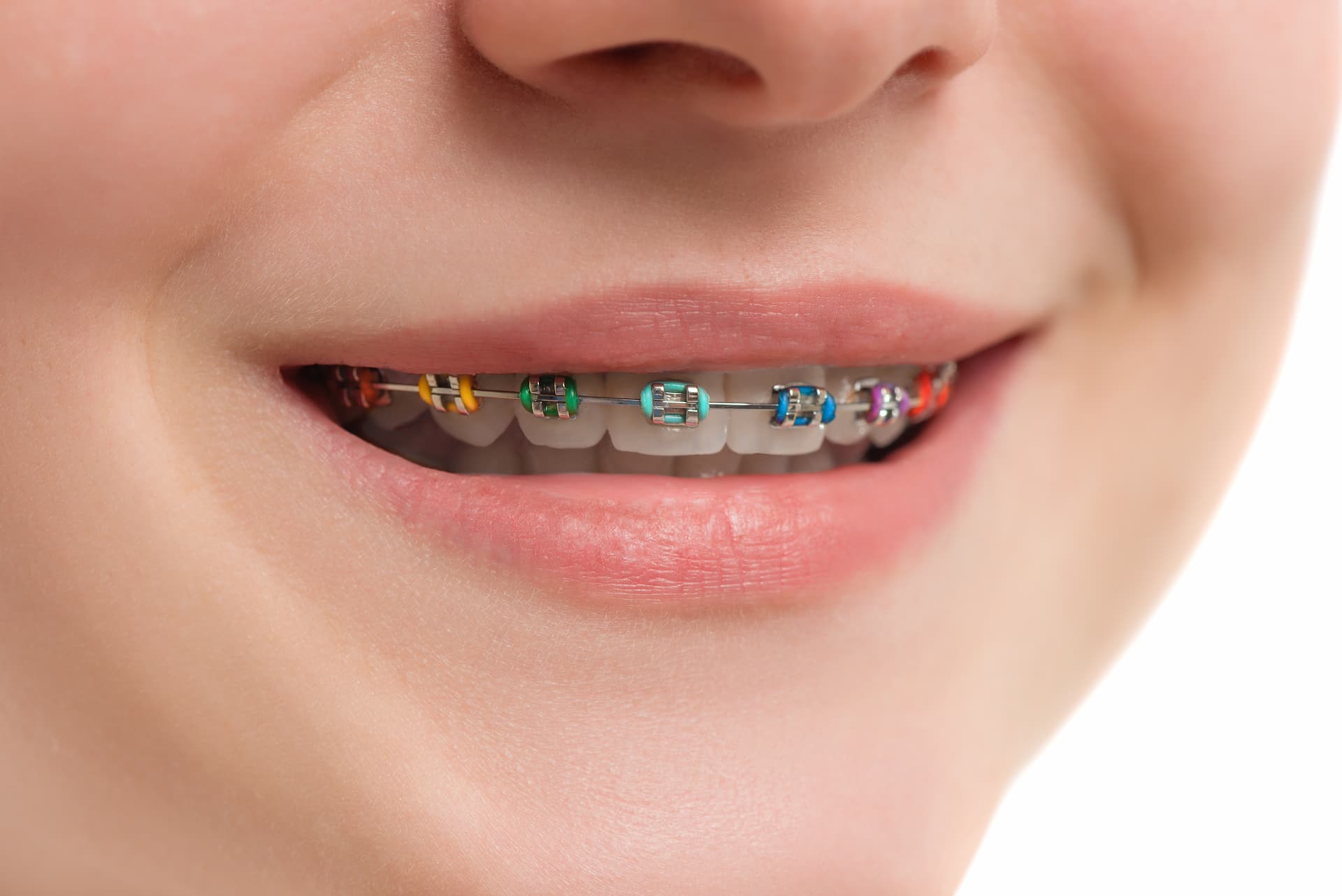 Metal Braces in Dubai