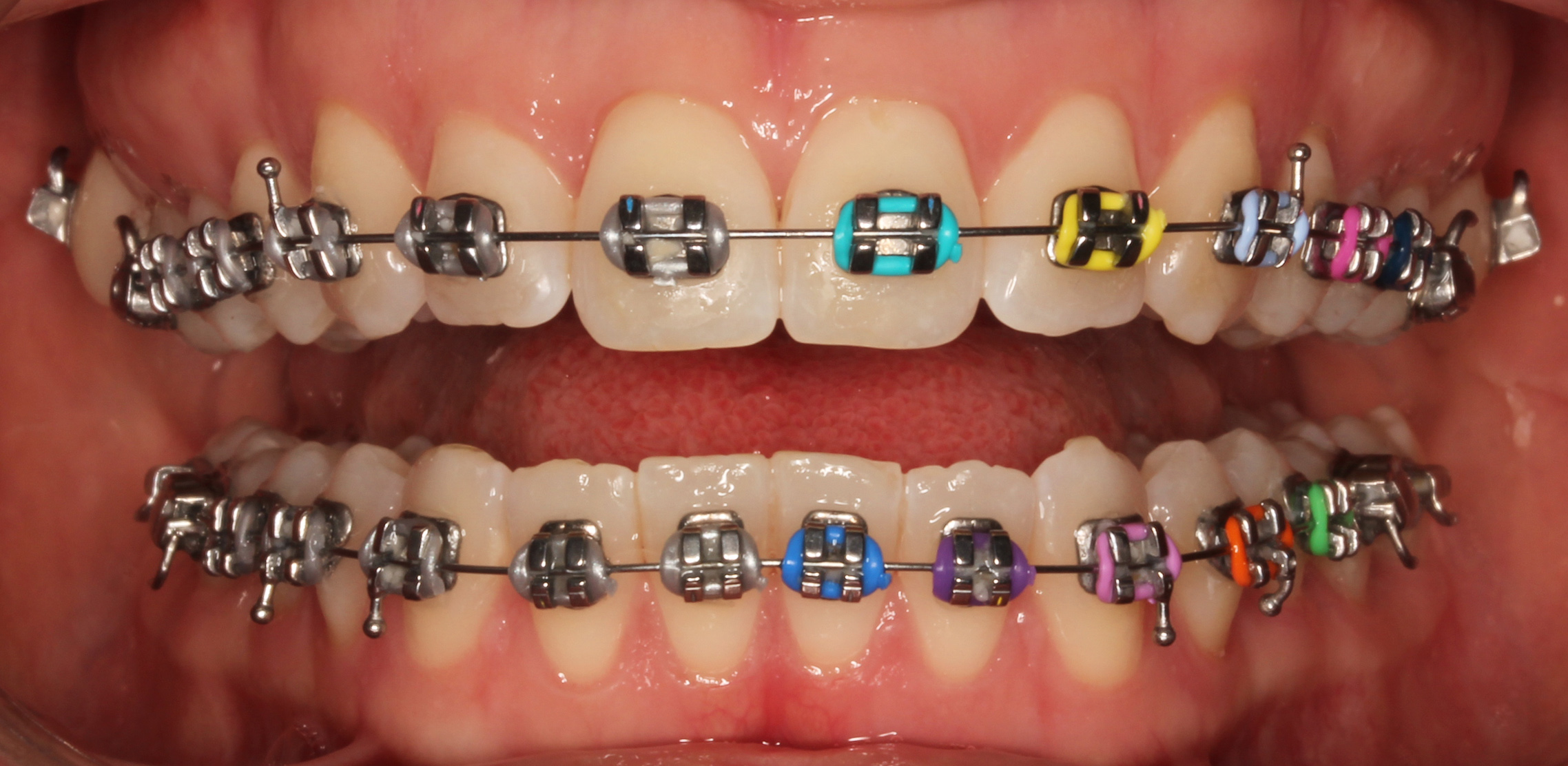 Metal Braces in Dubai