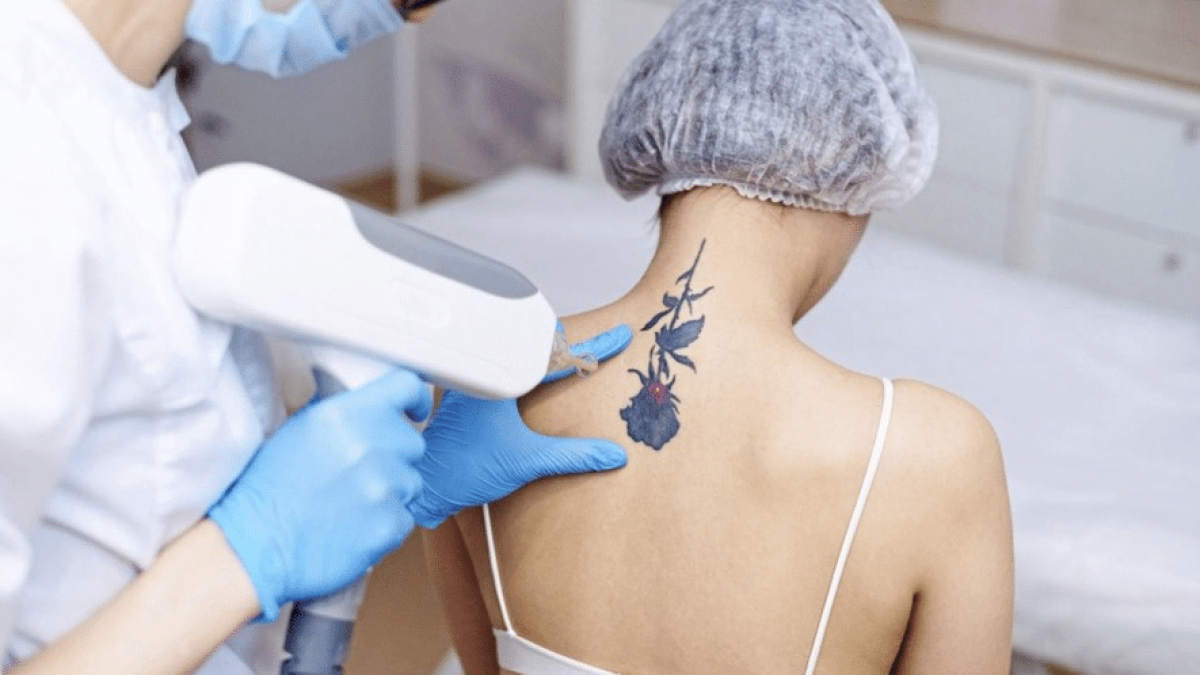 Laser Tattoo Removal in Dubai