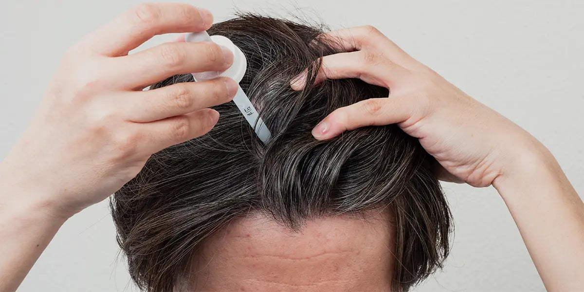 Hair Loss Treatment In Dubai