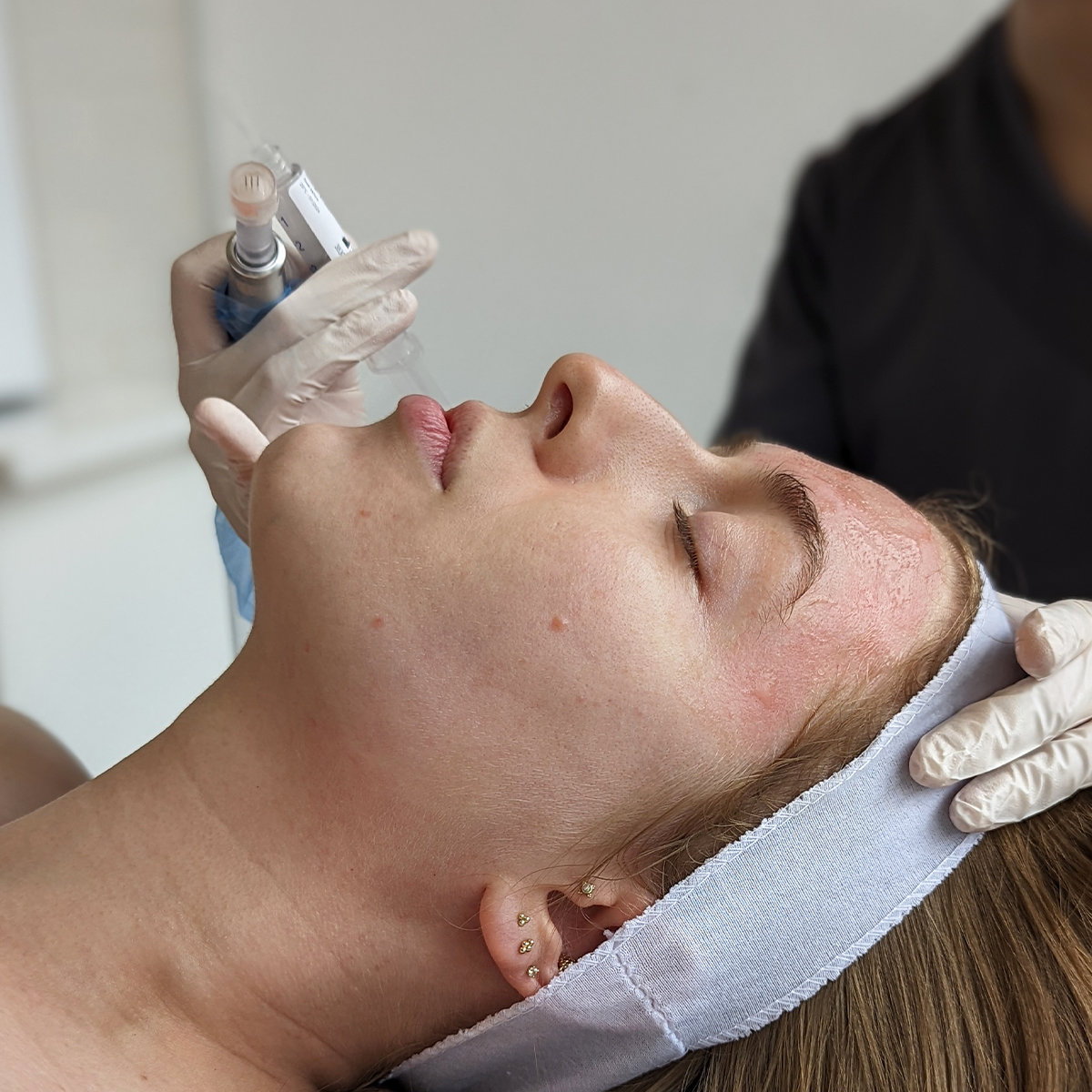 Microneedling in Dubai