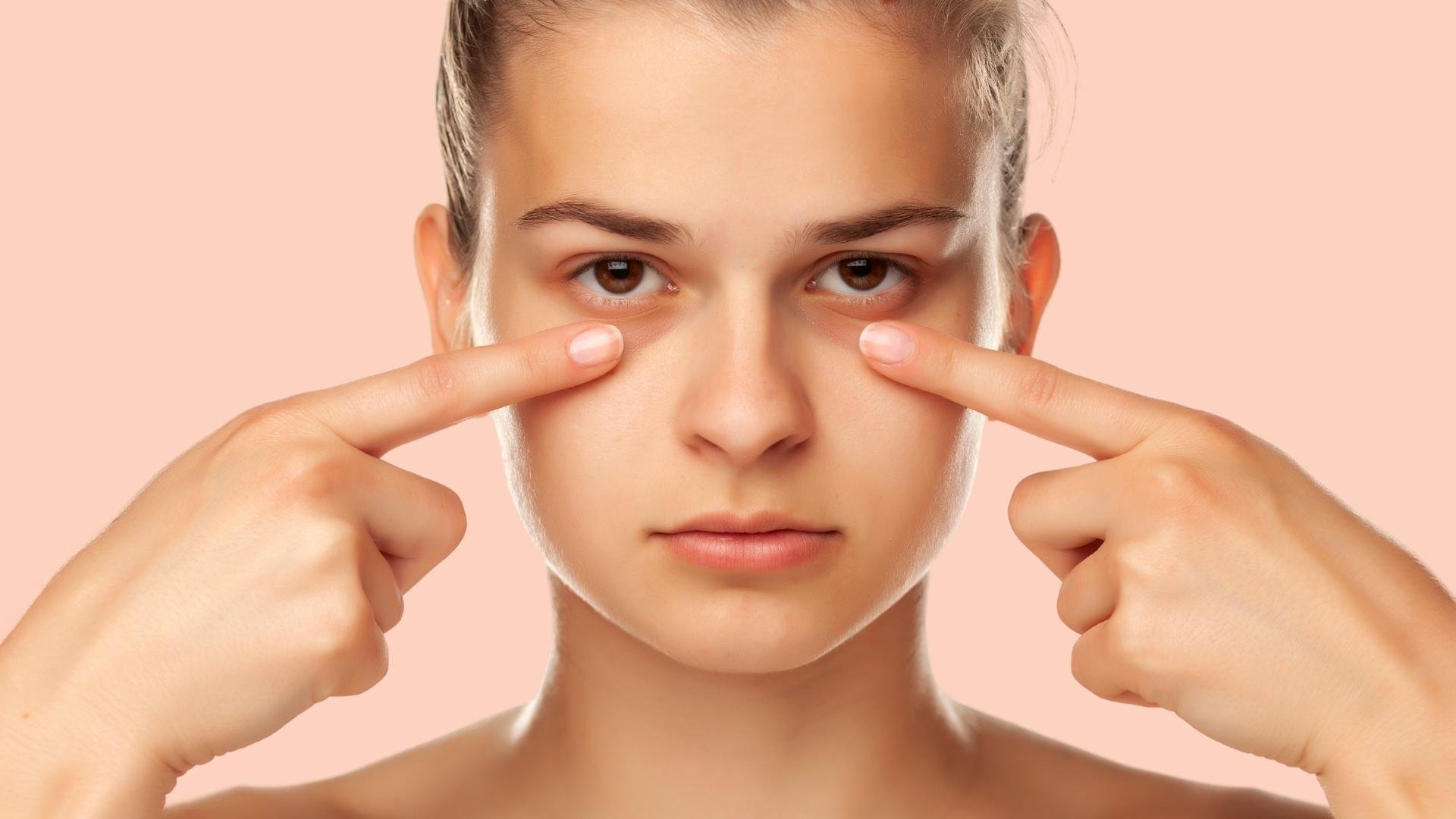 Dark Circles Treatment in Dubai