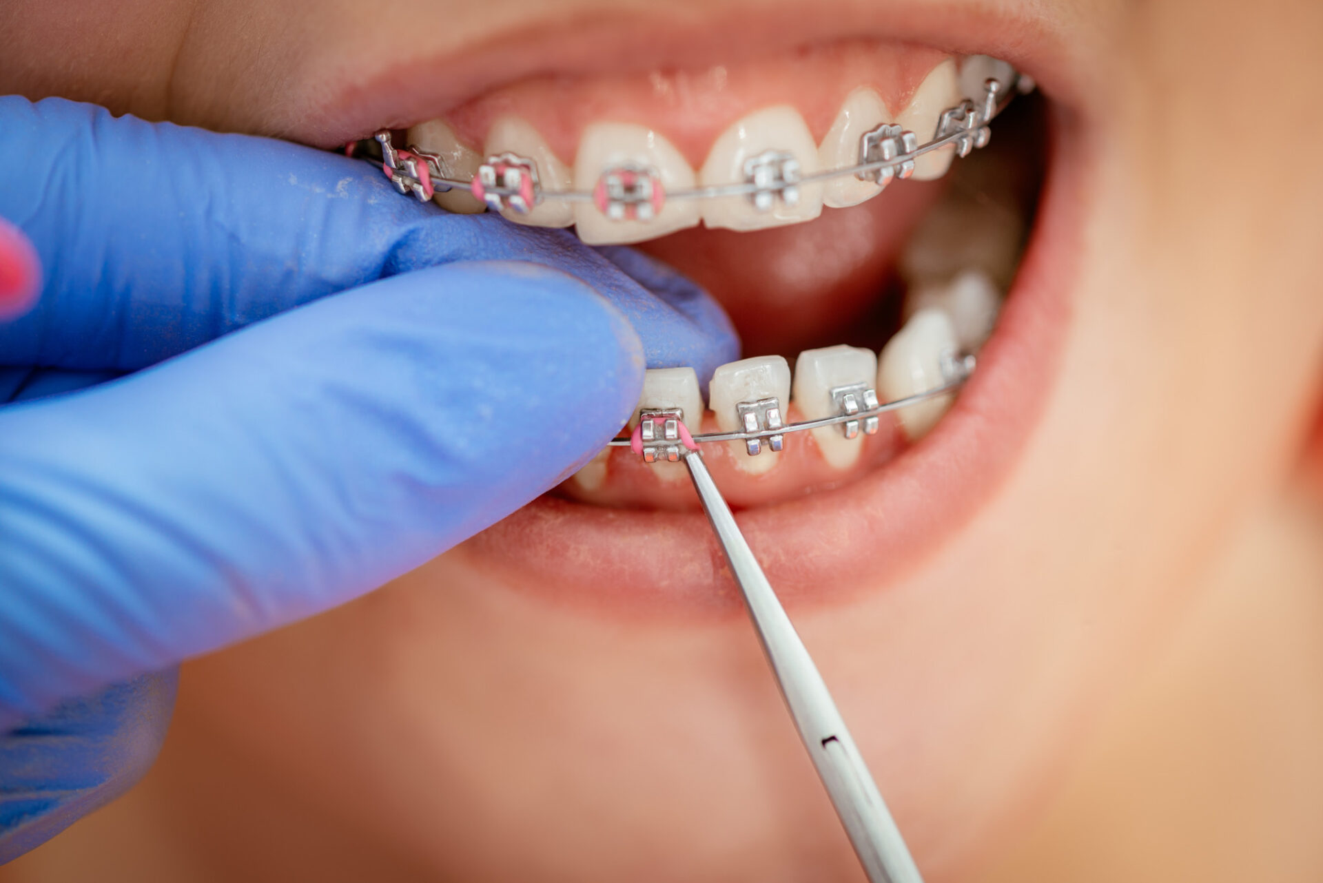 Metal Braces in Dubai