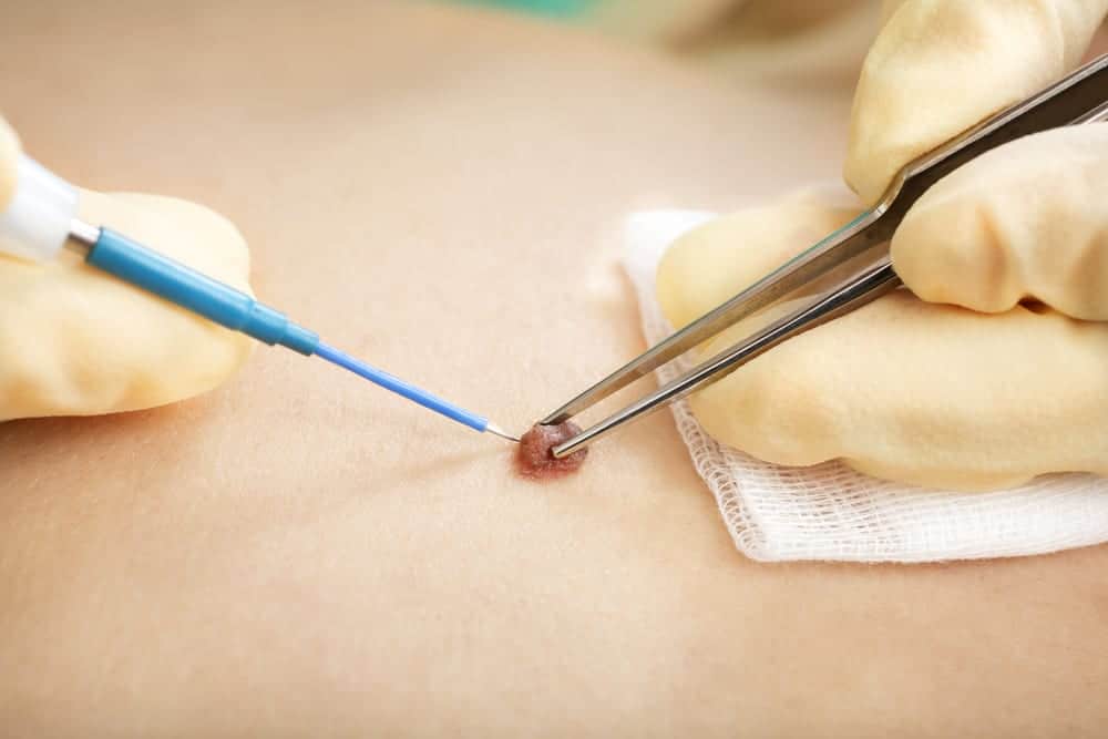 Mole Removal in Dubai