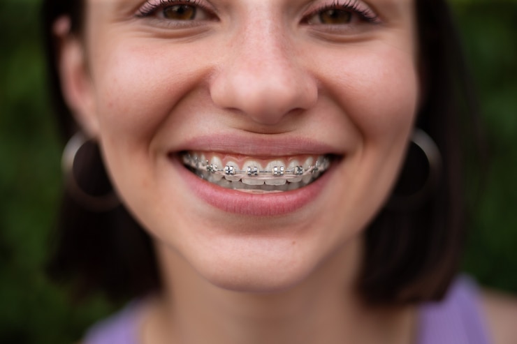 Metal Braces in Dubai