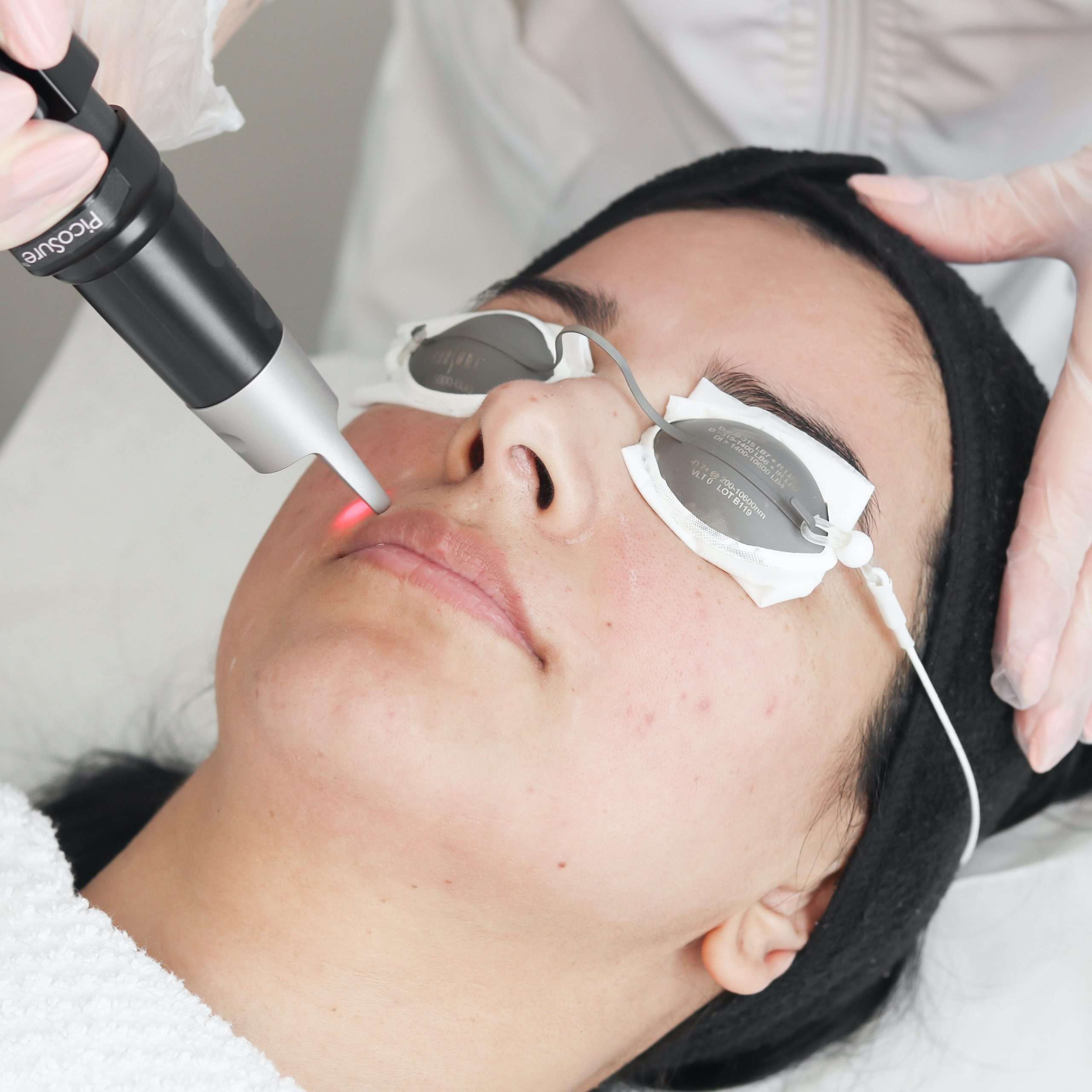 Pico Laser Treatment in Dubai