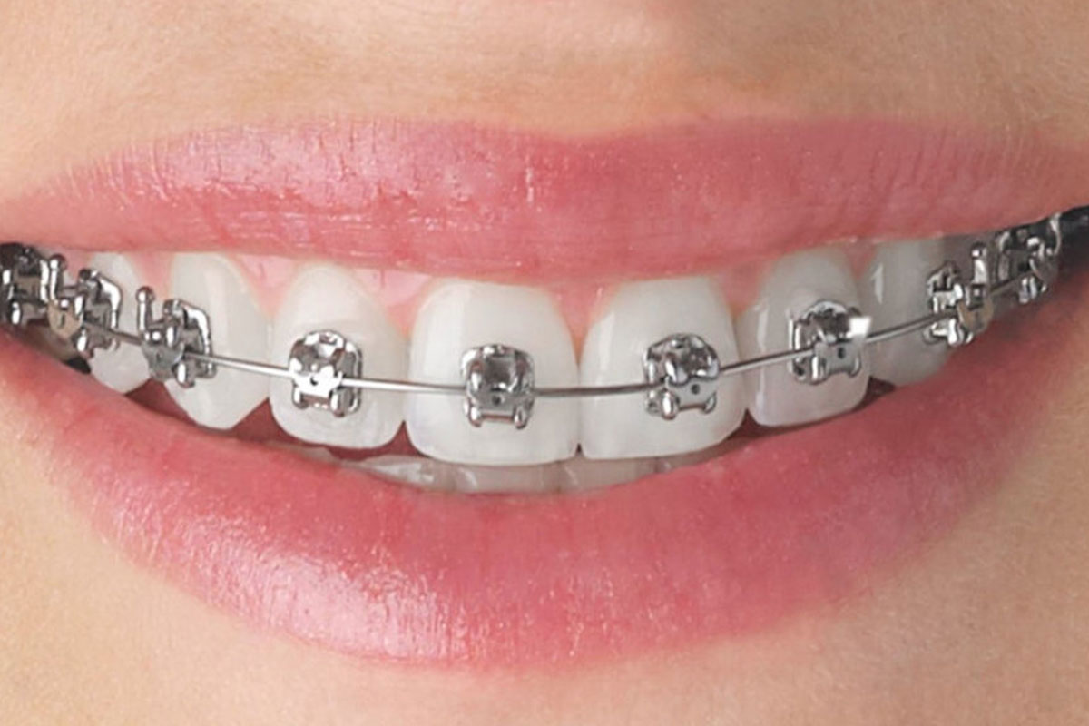 Metal Braces in Dubai