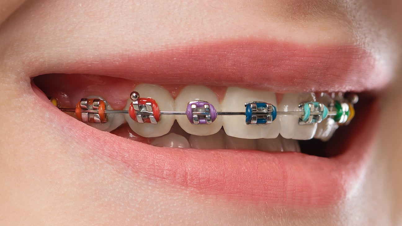 Metal Braces in Dubai